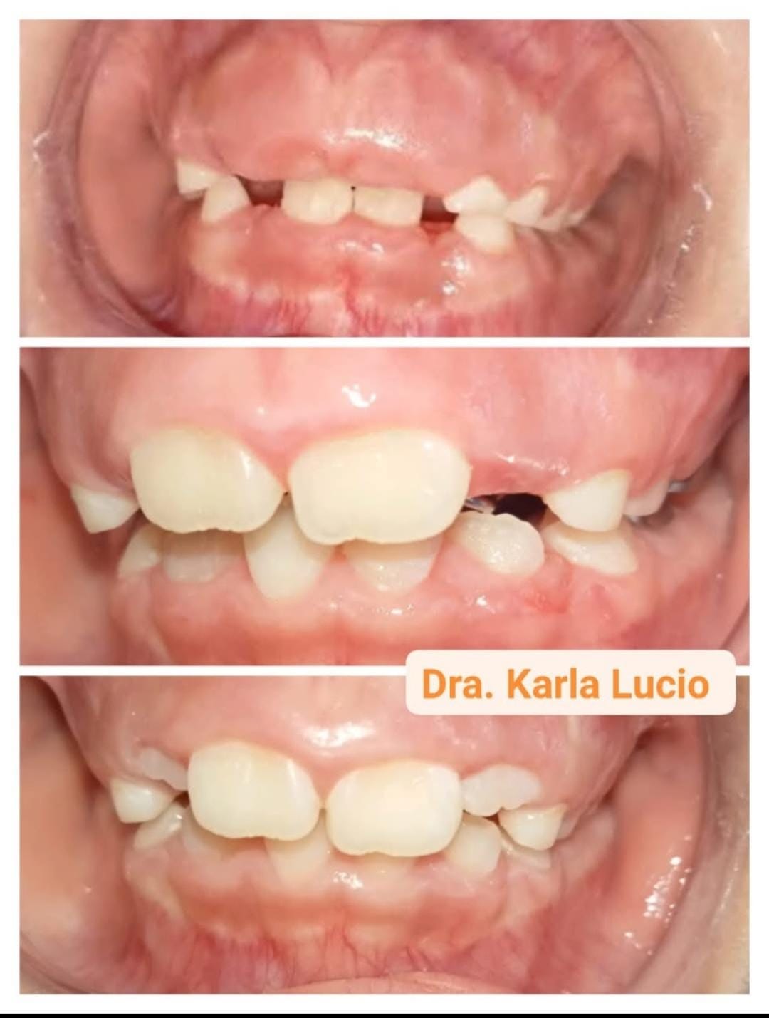 Ulectomia dental.