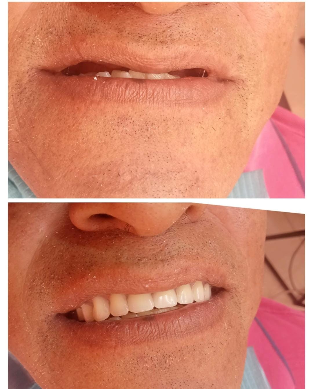 Prótesis dental superior total