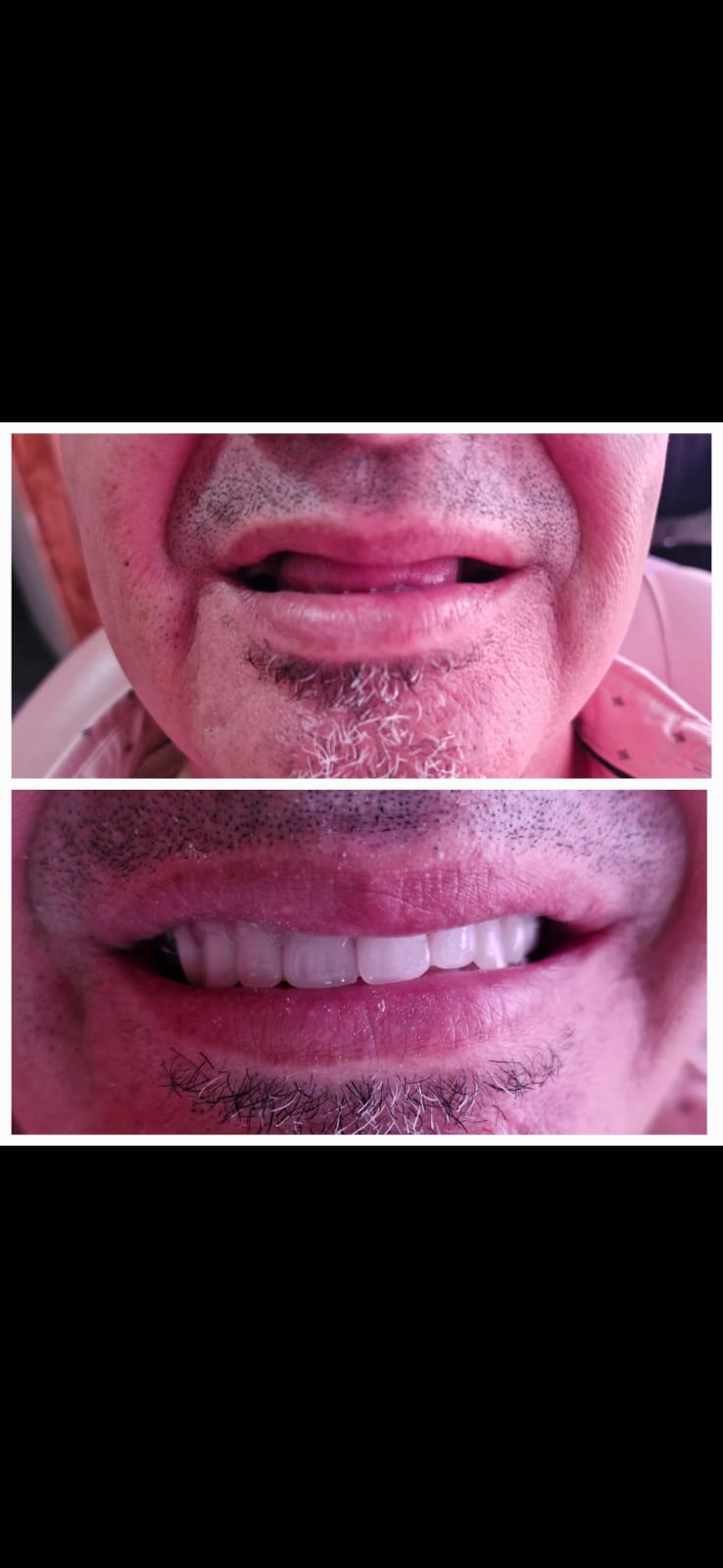 Protesis total superior