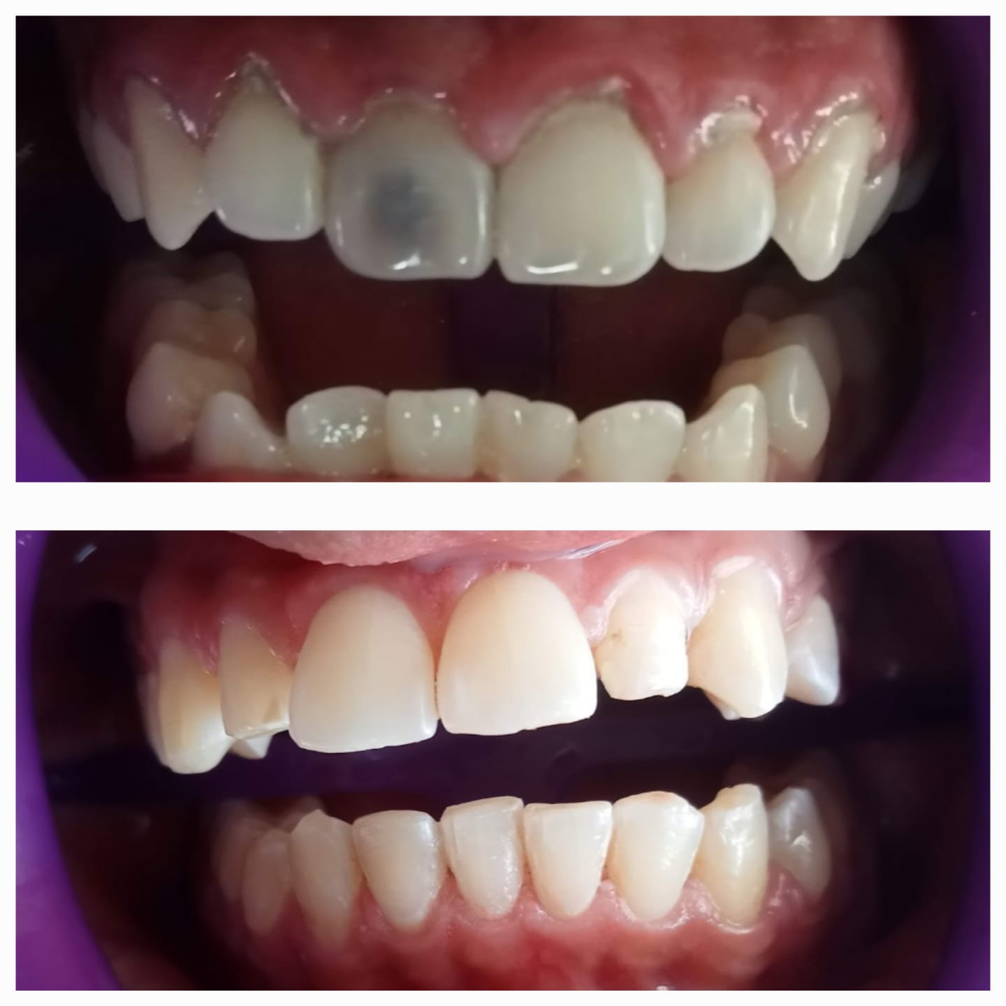 Limpieza dental + Blanqueamiento dental interno